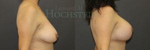 Breast Lift With Implants Patient