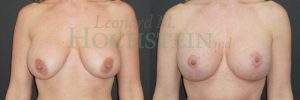 Breast Lift Patient 200