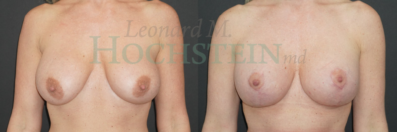 Breast Lift With Implants Patient
