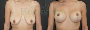 Breast Lift With Implants Patient