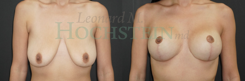 Breast Lift With Implants Patient