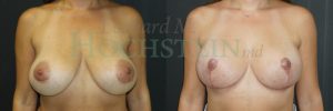 Breast Lift With Implants Patient