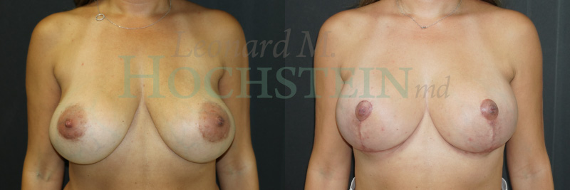 Breast Lift With Implants Patient