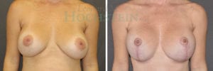 Breast Lift With Implants Patient