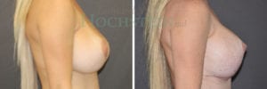 Breast Lift With Implants Patient