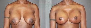 Breast Revision Patient