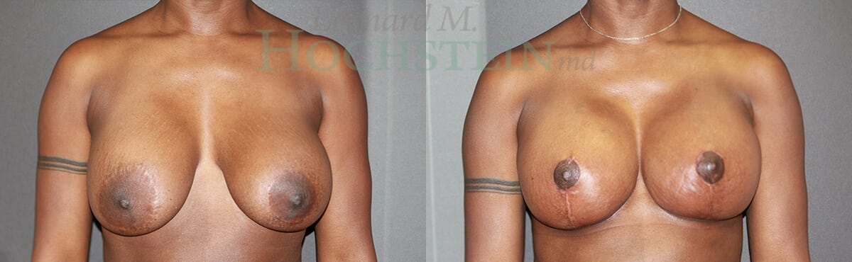 Breast Revision Patient