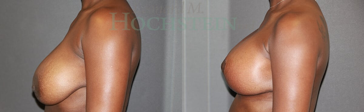 Breast Revision Patient