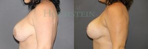 Breast Revision Patient