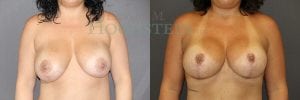 Breast Revision Patient