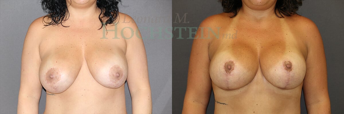 Breast Revision Patient