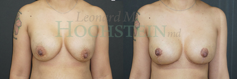 Breast Lift With Implants Patient
