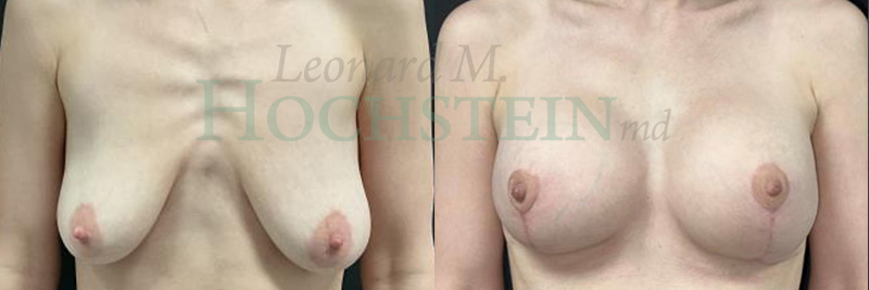 Breast Lift With Implants Patient