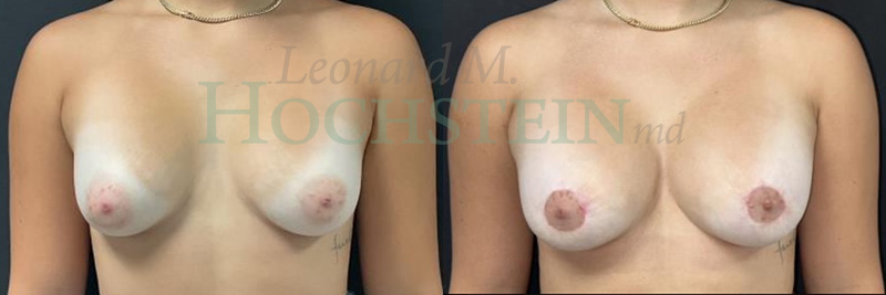 Breast Lift With Implants Patient