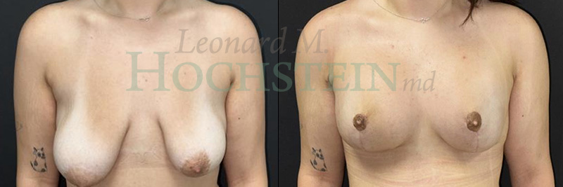Breast Lift With Implants Patient