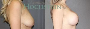 Breast Lift With Implants Patient