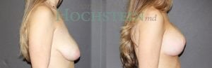Breast Lift With Implants Patient