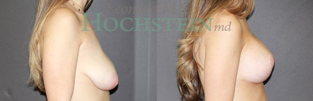 Breast Lift With Implants Patient