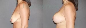 Breast Lift With Implants Patient