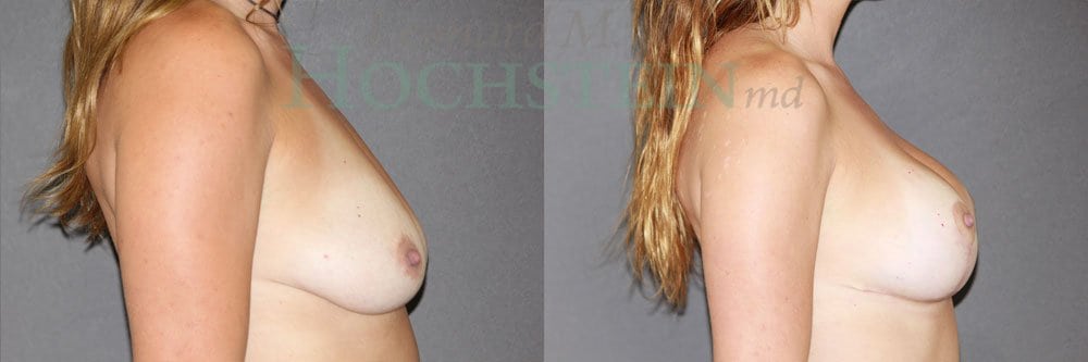 Breast Lift With Implants Patient