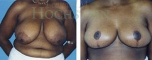 Breast Reduction Patient 01