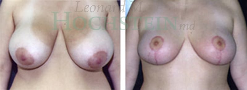 Breast Reduction/Lift (No Implants) Patient