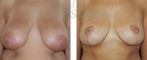 Breast Reduction/Lift (No Implants) Patient