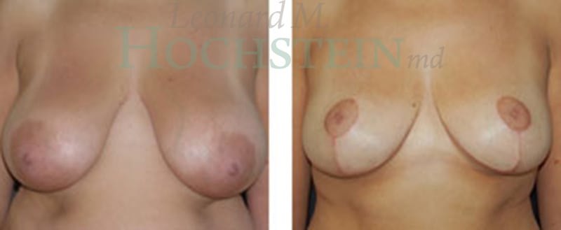 Breast Reduction/Lift (No Implants) Patient