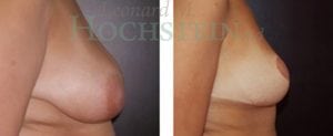 Breast Reduction/Lift (No Implants) Patient