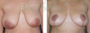 Breast Reduction/Lift (No Implants) Patient