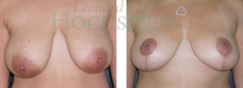 Breast Reduction/Lift (No Implants) Patient
