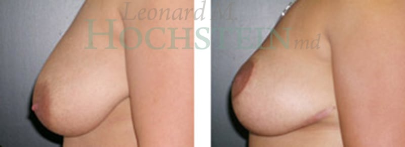 Breast Reduction/Lift (No Implants) Patient