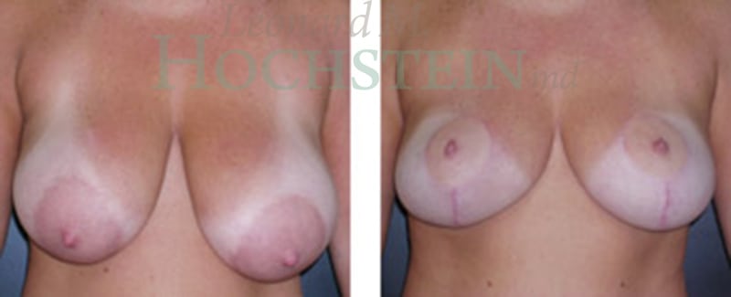 Breast Reduction/Lift (No Implants) Patient