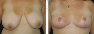 Breast Reduction/Lift (No Implants) Patient