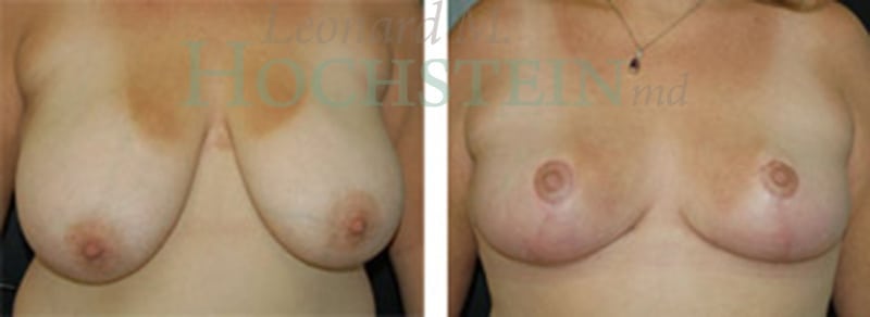 Breast Reduction/Lift (No Implants) Patient