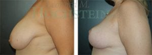 Breast Reduction/Lift (No Implants) Patient