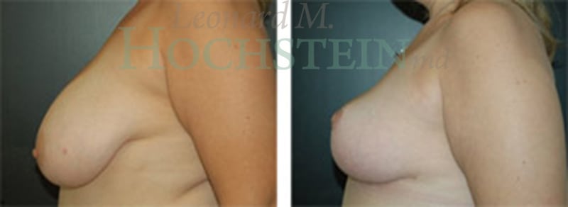Breast Reduction/Lift (No Implants) Patient