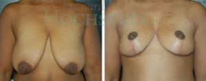 Breast Reduction/Lift (No Implants) Patient