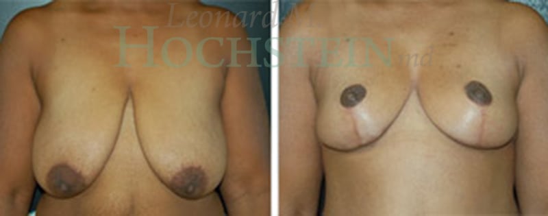 Breast Reduction/Lift (No Implants) Patient