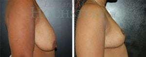 Breast Reduction/Lift (No Implants) Patient