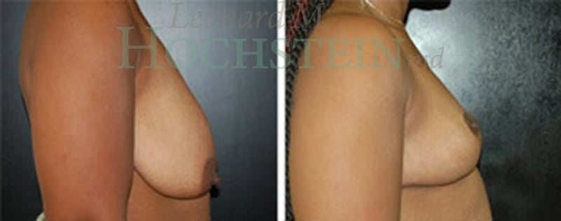 Breast Reduction/Lift (No Implants) Patient
