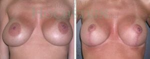 Breast Revision Patient 91