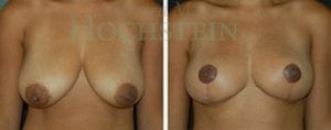 Breast Reduction/Lift (No Implants) Patient