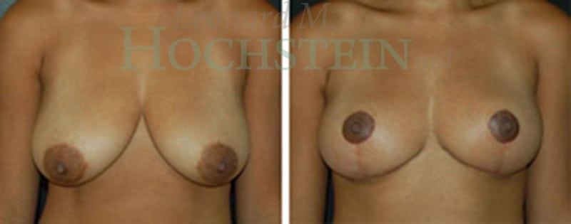 Breast Reduction/Lift (No Implants) Patient