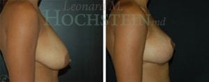 Breast Reduction/Lift (No Implants) Patient