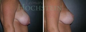 Breast Reduction/Lift (No Implants) Patient
