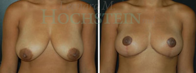 Breast Reduction/Lift (No Implants) Patient