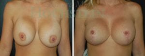 Breast Lift With Implants Patient