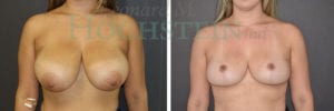 Breast Reduction/Lift (No Implants) Patient