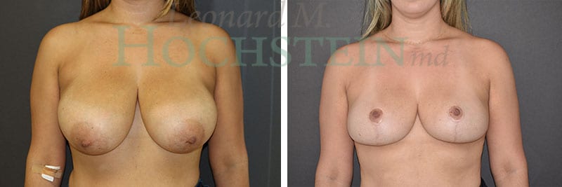 Breast Reduction/Lift (No Implants) Patient